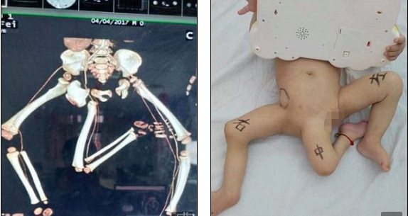 Ù†ØªÙŠØ¬Ø© Ø¨Ø­Ø« Ø§Ù„ØµÙˆØ± Ø¹Ù† â€ªBaby born with three legs undergoes 10 hour surgery to have extra limb from parasitic twin removedâ€¬â€